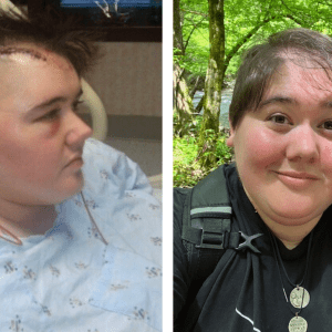 Kaitlin Ferguson (left) in 2012 after her strokes and (right) in 2023.  